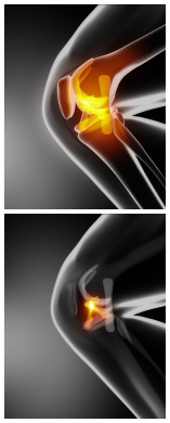 ACL Reconstruction (Knee Surgery)
